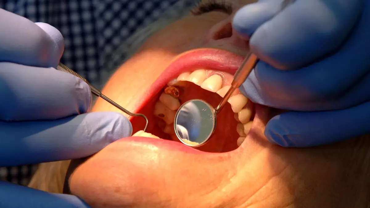 nottingham universitesinden dis minesini onaran yeni jel G8BD2Plm.jpg